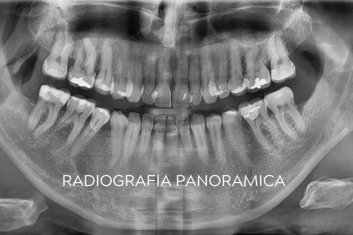exames para implante dentario radiografia panoramica