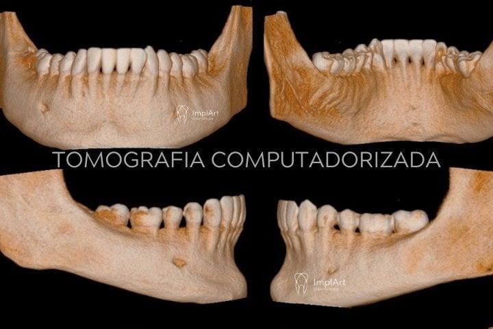 EXAMES PARA IMPLANTE DENTARIO TOMOGRAFIA