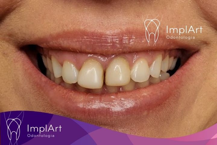 antes da cirurgia de implante dentario de um dente frontal