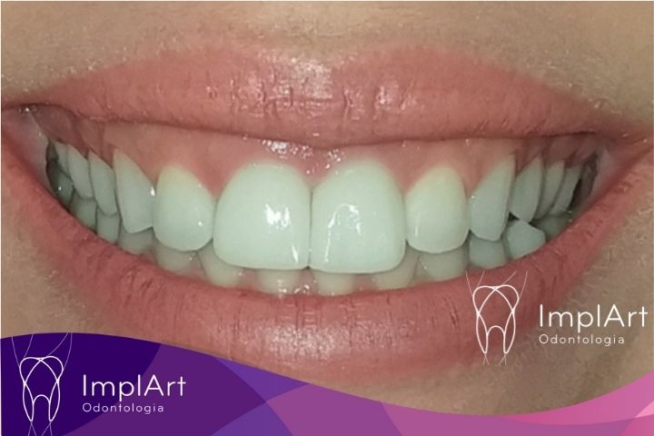 após algumas semanas do implante dentario de um dente da frente