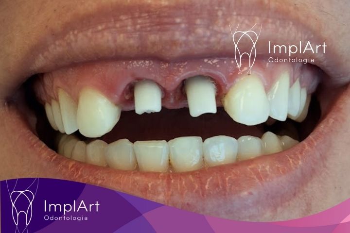 após a cirurgia de implante dentario frontal

