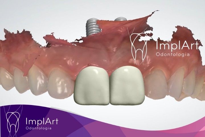 projeto de coroas frontais sobre implante dentario de um dente
