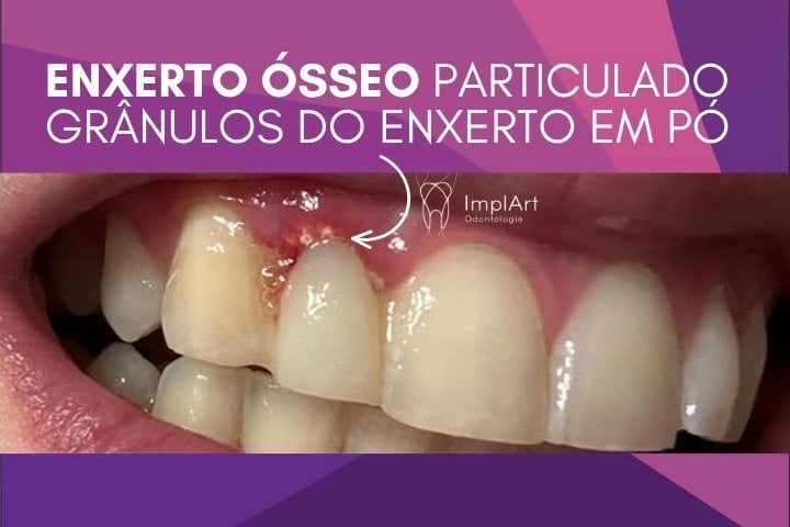 Enxerto ósseo em granulos sendo expelido pelo organismo