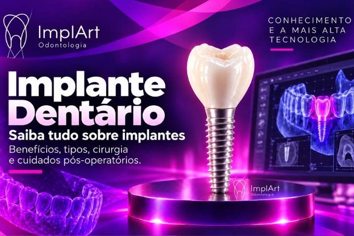 tudo sobre implantes dentarios