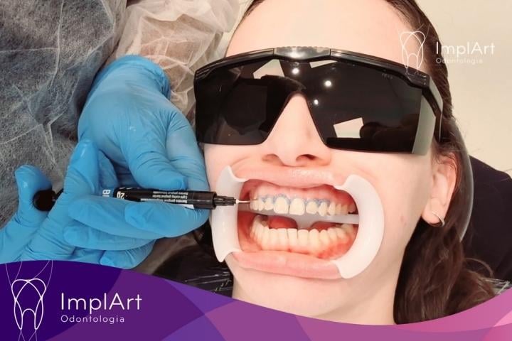 Clareamento dentário sem sensibilidade - Clareamento dental a laser CLAREAMENTO DENTAL A LASER BARREIRA DE PROTEÇÃO PARA SENSIBILIDADE