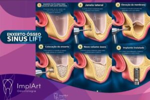 Enxerto do Seio Maxilar (Sinus Lift): quando é indicado e como é realizado enxerto sinus
