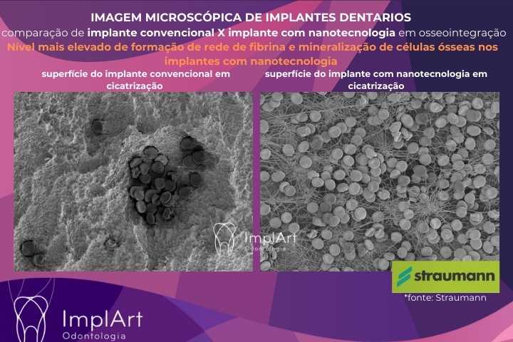 implante com nanotecnologia
