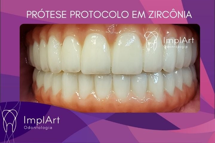 implannte total 1 mês protese protocolo zirconia