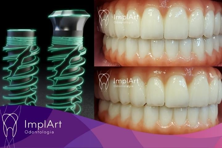 implante total em 1 Mês