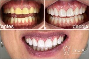Dental contact lenses: step-by-step treatment Dental contact lenses