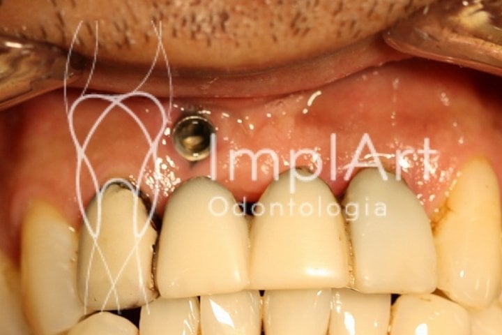 Especialistas em Corrigir Implante Dentário Mal Feito em São Paulo foto de implante dentario mal feito