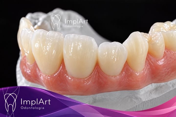 PROTESE DE ZIRCONIA