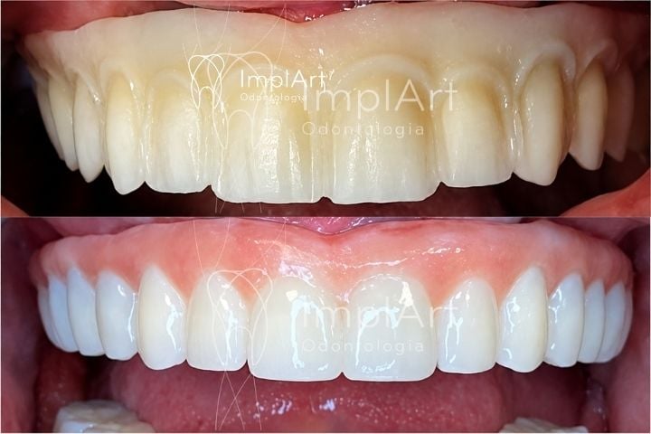 Tratamento com implante dentário rápido com implante Slactive + prótese de zircônia pura ou porcelana pura prótese protocolo em zirconia sobre implantes