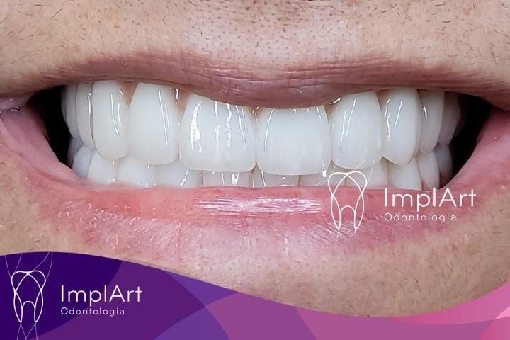 prótese protocolo com implante em zirconia e porcelana
