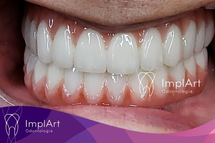 DOUBLE ARCH DENTAL IMPLANTS