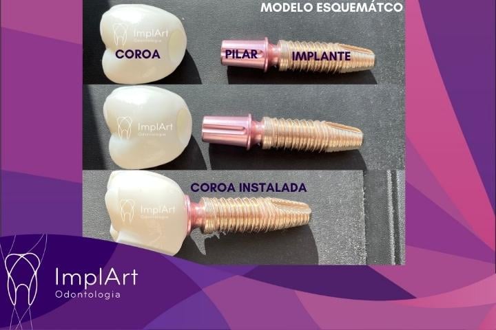 etapas implante sem parafuso
