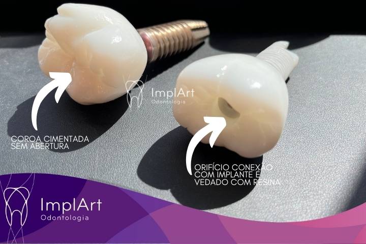implante sem parafuso e implante com parafuso , comparativo