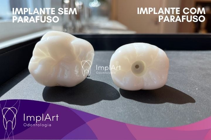 implante sem parafuso
