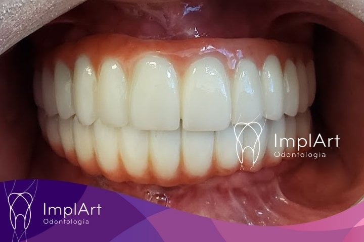 DOUBLE ARCH DENTAL IMPLANTS