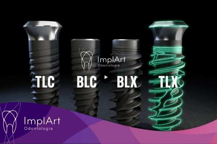Implante Straumann iExcel tem quatro designs BLX, BLC, TLX e TLC
