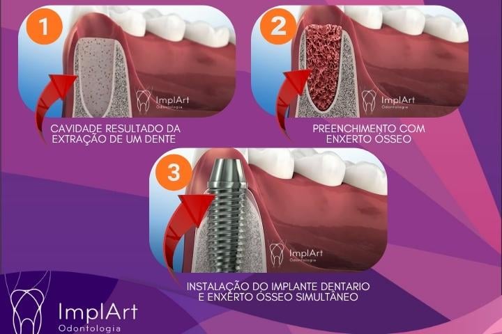 implante dentario com enxerto