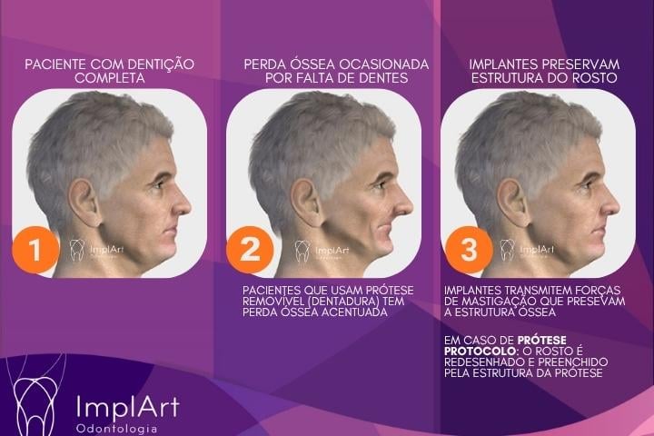 perda óssea e implante dentario com enxerto ósseo