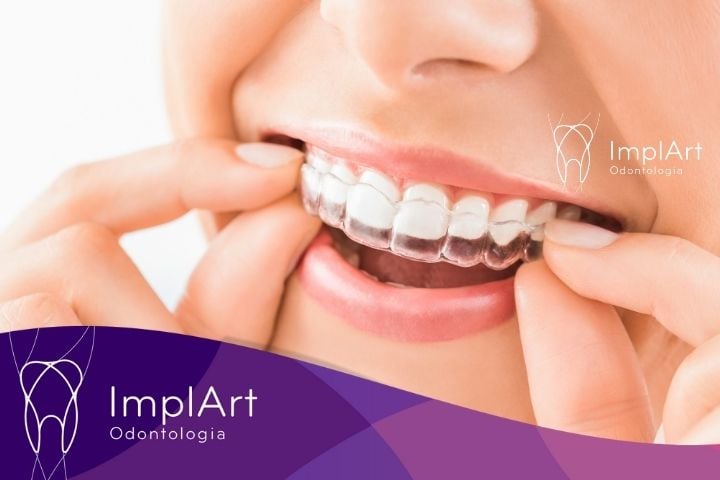 Riscos de Usar Aparelho Ortodôntico por Muito Tempo riscos de usar aparelho