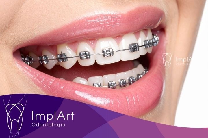Riscos de Usar Aparelho Ortodôntico por Muito Tempo aparelho ortodontico fixo tem baixos riscos de usar aparelho