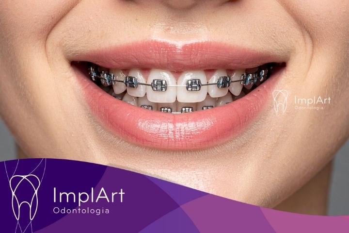 Riscos de Usar Aparelho Ortodôntico por Muito Tempo riscos de usar aparelho