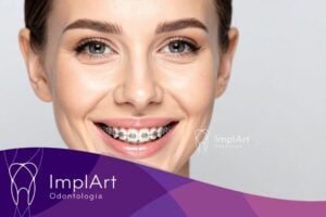 aparelho ortodontico