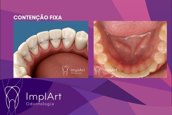 Riscos de Usar Aparelho Ortodôntico por Muito Tempo riscos de usar aparelho