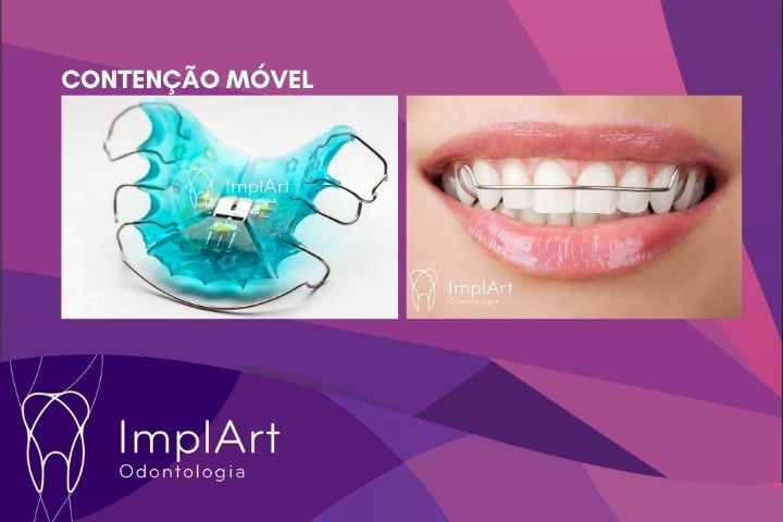 Riscos de Usar Aparelho Ortodôntico por Muito Tempo contenção ortodontica