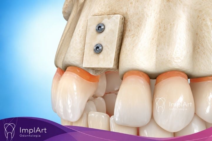 enxerto &oacute;sseo dentario em bloco