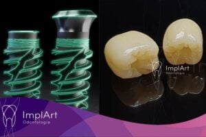 Implante dentário completo