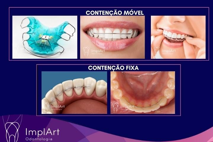 Riscos de Usar Aparelho Ortodôntico por Muito Tempo usar contenção ortodontica reduz riscos de usar aparelho