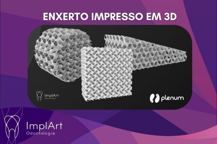 enxerto ósseo 3d customizado