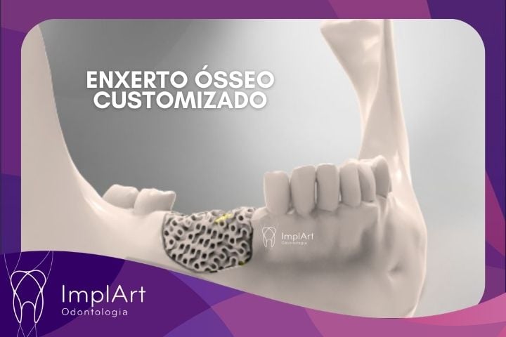 enxerto ósseo 3d personalizado