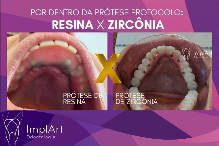 Prótese Protocolo em Resina ou Zircônia: o que ninguém conta (verdades que fazem diferença no seu implante dentário) palato protese protocolo resina comparada com zirconia