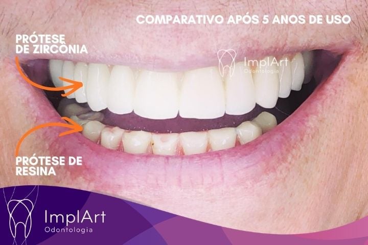 Prótese Protocolo em Resina ou Zircônia: o que ninguém conta (verdades que fazem diferença no seu implante dentário) protese protocolo resina comparada com protocolo porcelana