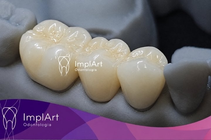 Coroas de Porcelana na clinica implart em são paulo