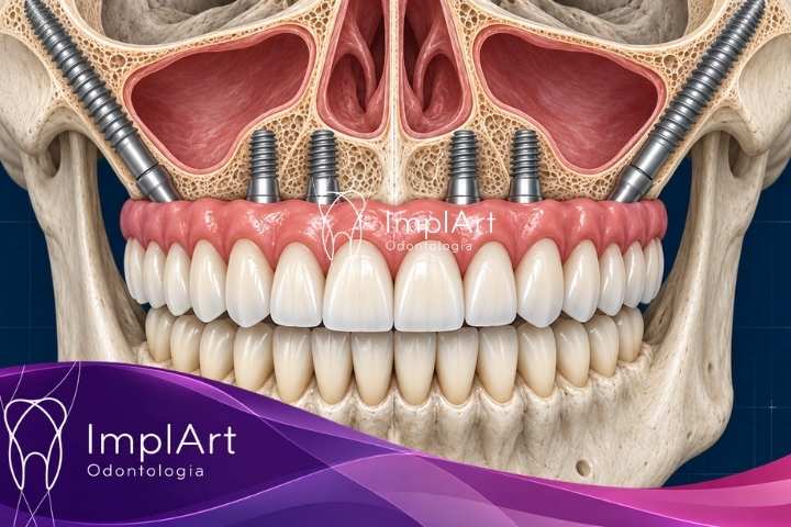 Zygomatic implants placed