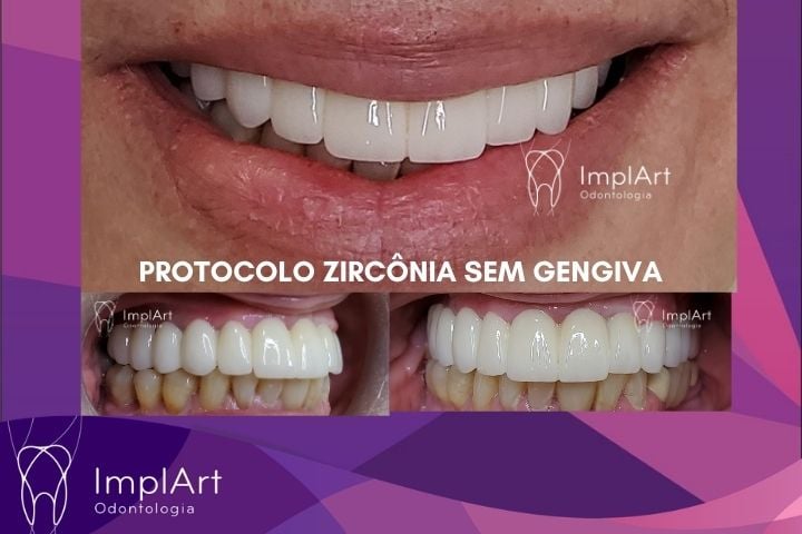 PROTESE PROTOCOLO EM ZIRCONIA SEM GENGIVA
