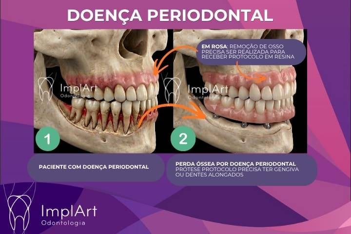 pr&oacute;tese protocolo sem gengiva