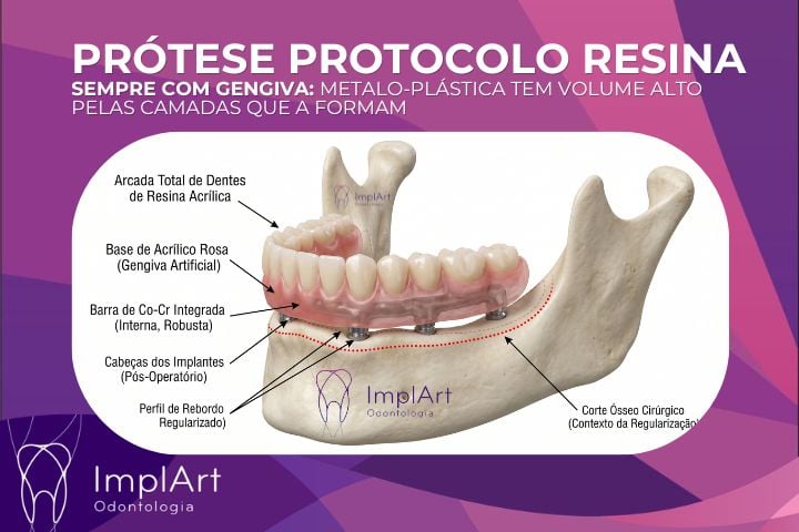 Pr&oacute;tese protocolo sobre implantes dent&aacute;rios em Resina