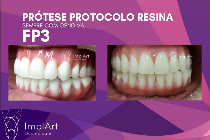 Pr&oacute;tese Protocolo em Resina FP3: Protocolo com Gengiva para perda &oacute;ssea intensa, ou para quem sofreu a cirurgia de remo&ccedil;&atilde;o de rebordo for&ccedil;ada 