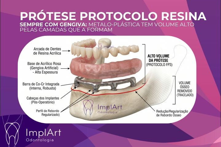 Pr&oacute;tese Protocolo em Resina e suas camadas