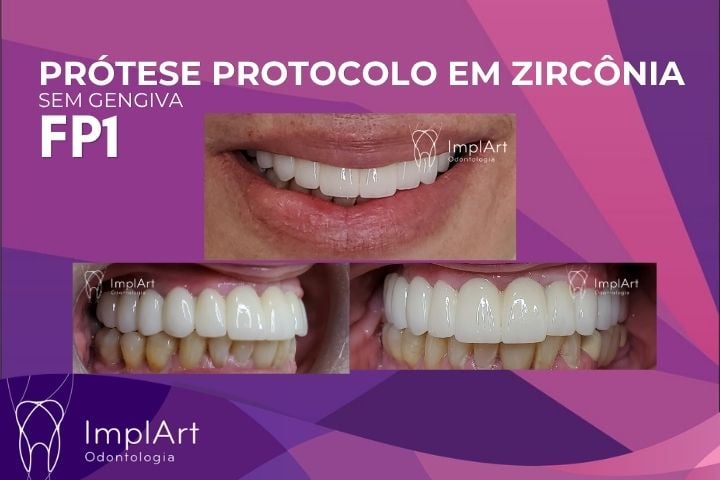 Pr&oacute;tese Protocolo em Zirconia tipo FP1: Protocolo sem Gengiva. Estrutura &oacute;ssea preservada e naturalidade com Zirc&ocirc;nia.
