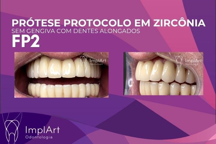 pr&oacute;tese protocolo sem gengiva