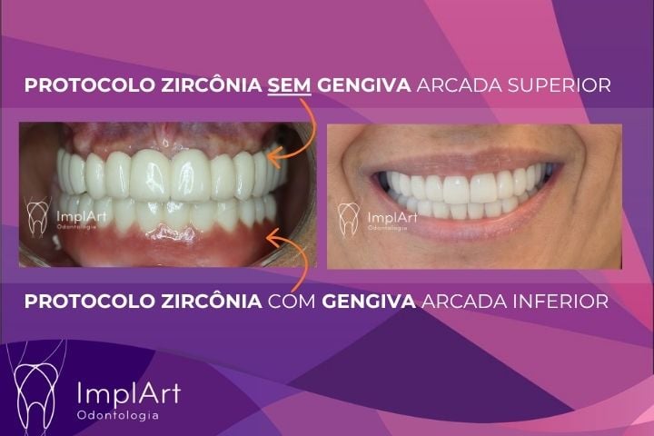 Pr&oacute;tese protocolo Sem gengiva na arcada superior em zirconia
