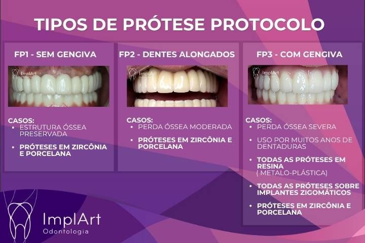 Classifica&ccedil;&atilde;o Prot&eacute;tica de Misch: FP1 - Pr&oacute;tese Protocolo sem gengiva, FP2 - Pr&oacute;tese com dentes alongados, FP3 - Pr&oacute;teses com gengiva